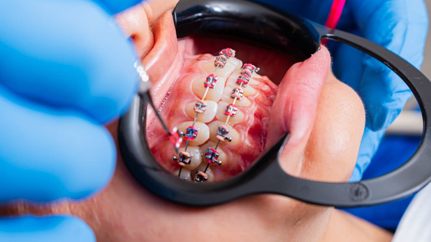 Orthodontic braces being checked